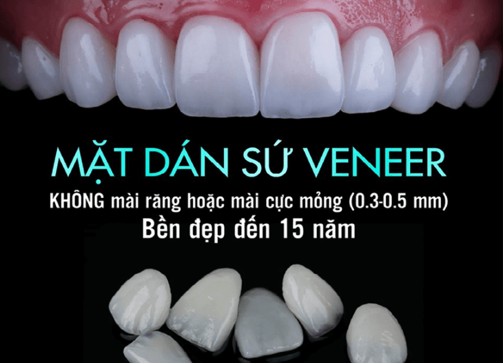 Dán răng sứ Veneer khắc phục khuyết điểm trên răng