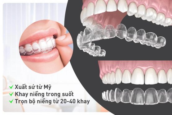 Nẹp răng trong suốt là gì? Chi phí niềng răng trong suốt mới nhất