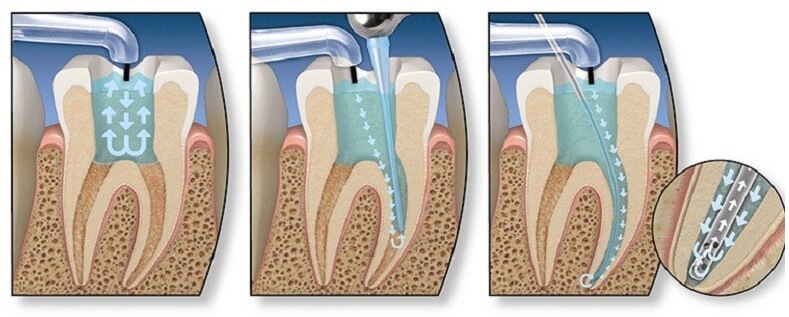 Thời gian điều trị tủy răng tùy thuộc vào tình trạng bệnh