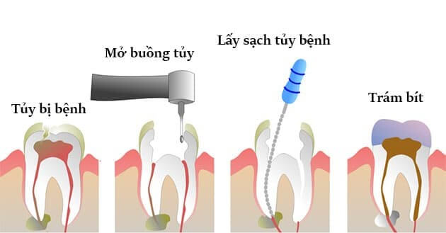 Nên chữa viêm tủy răng ở đâu uy tín, chất lượng