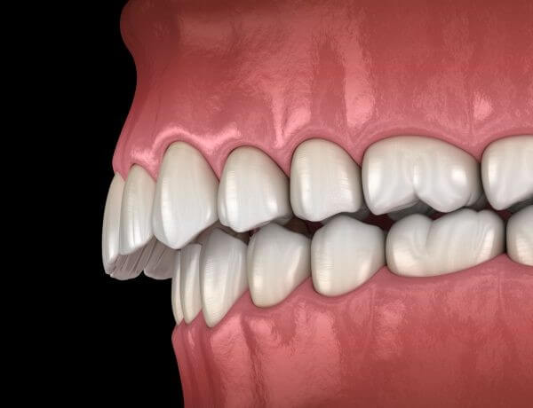 Răng hô hay còn gọi là răng vẩu