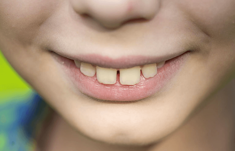 Răng bị vẩu có thể do những thói quen xấu khi còn nhỏ