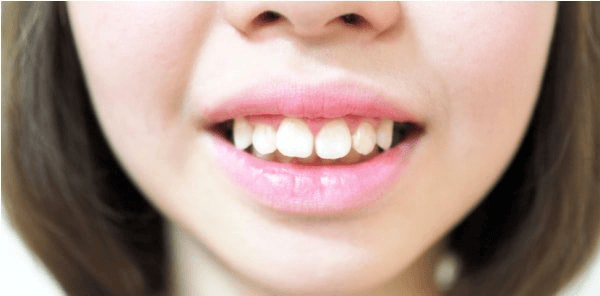 Răng vẩu là gì?