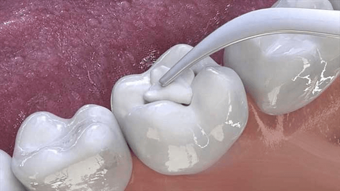 Định nghĩa trám răng lấy tủy