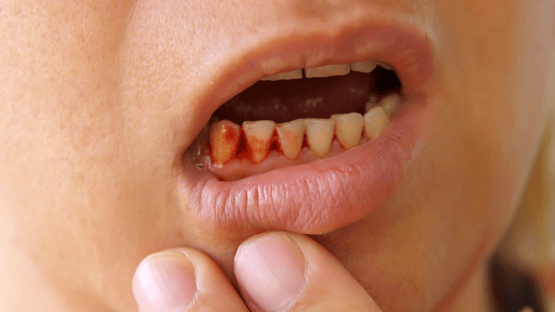 Viêm chân răng uống thuốc gì nhanh khỏi? Những lưu ý cần biết
