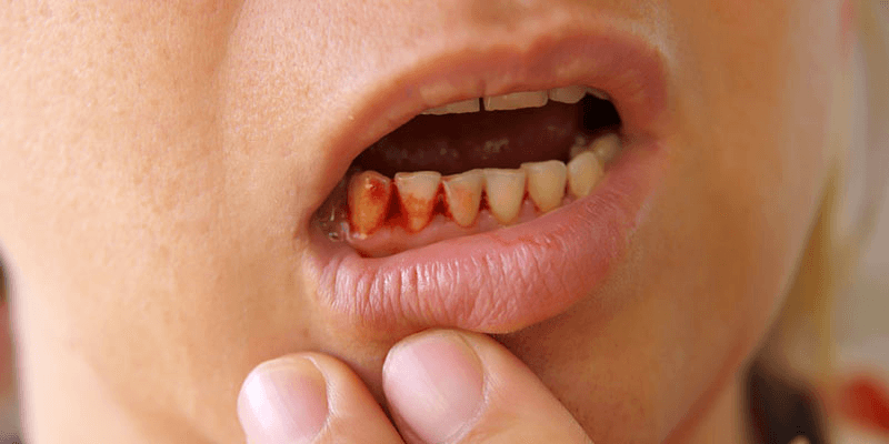Tổng quan về bệnh lý viêm chân răng