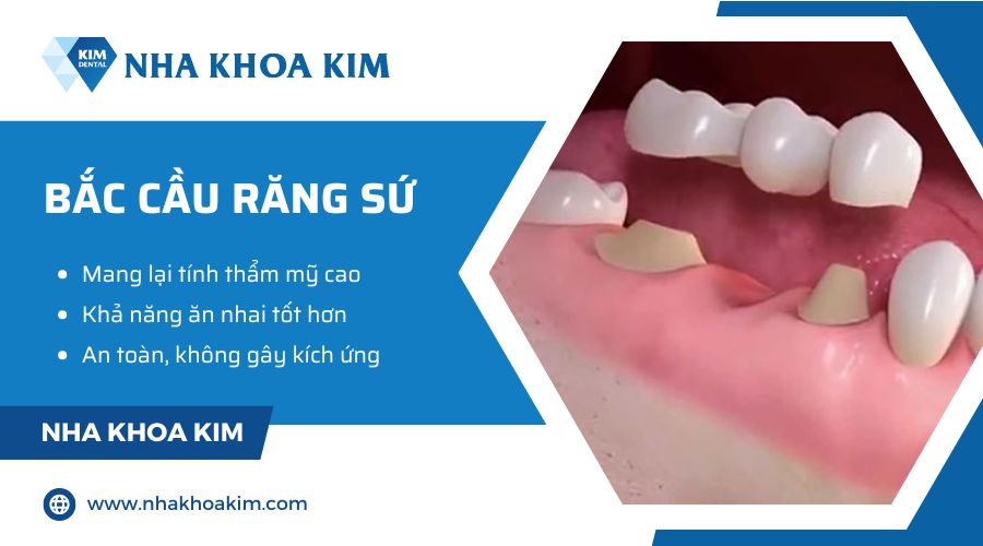 bắc cầu răng sứ
