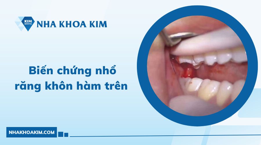 biến chúng nhổ răng khôn hàm trên