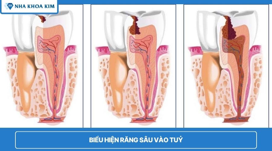Biểu hiện khi răng sâu vào tủy