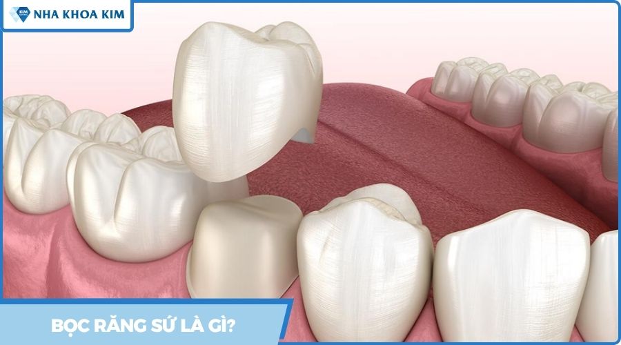 bọc răng sứ là gì?