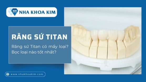 Răng sứ Titan có mấy loại? Bọc loại nào tốt nhất?