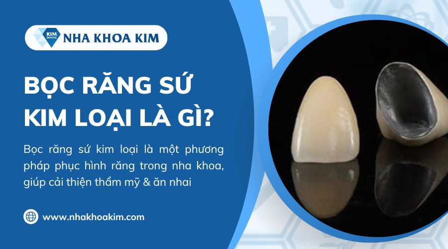 răng bọc sứ bằng kim loại là gì?