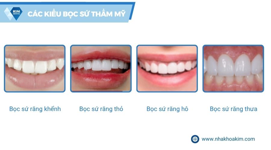 các kiểu bọc răng sứ
