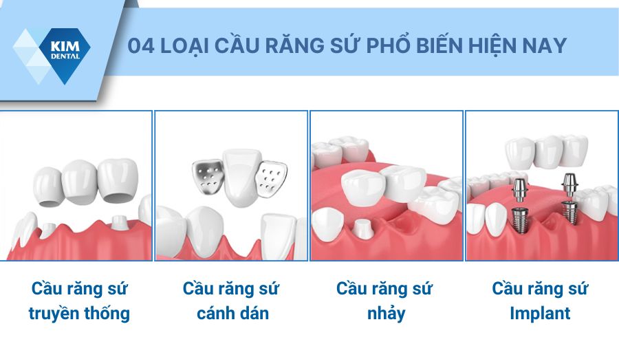 các loại cầu răng sứ