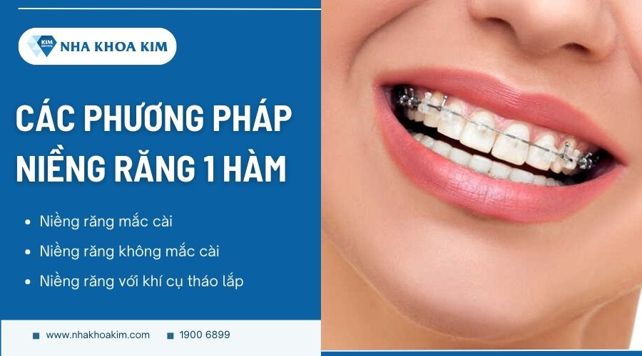 Niềng răng 1 hàm bằng phương pháp nào hiệu quả?