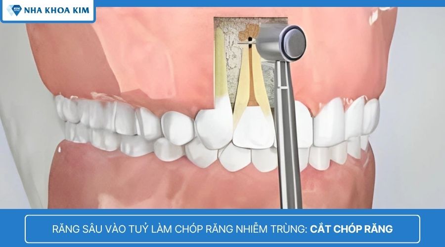 cắt chóp răng