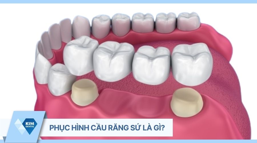 cầu răng sứ là gì?