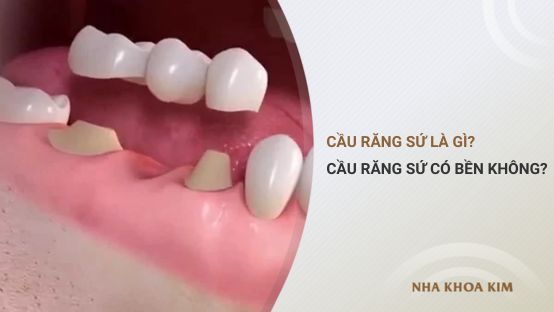 Cầu Răng Sứ Là Gì? Ưu Và Nhược Điểm Của Cầu Răng Sứ