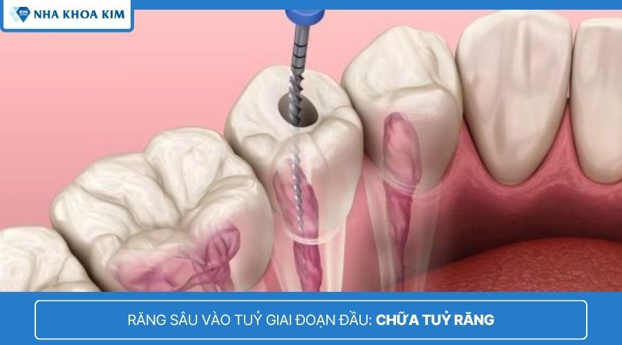 điều trị tủy răng