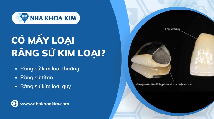 răng sứ kim loại có mấy loại
