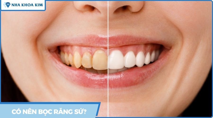 có nên bọc răng sứ không