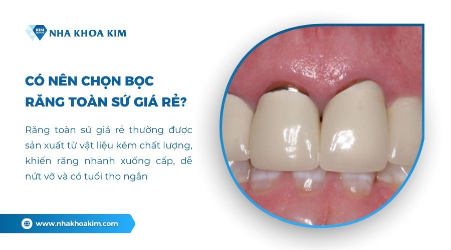 Có nên chọn bọc răng toàn sứ giá rẻ không?