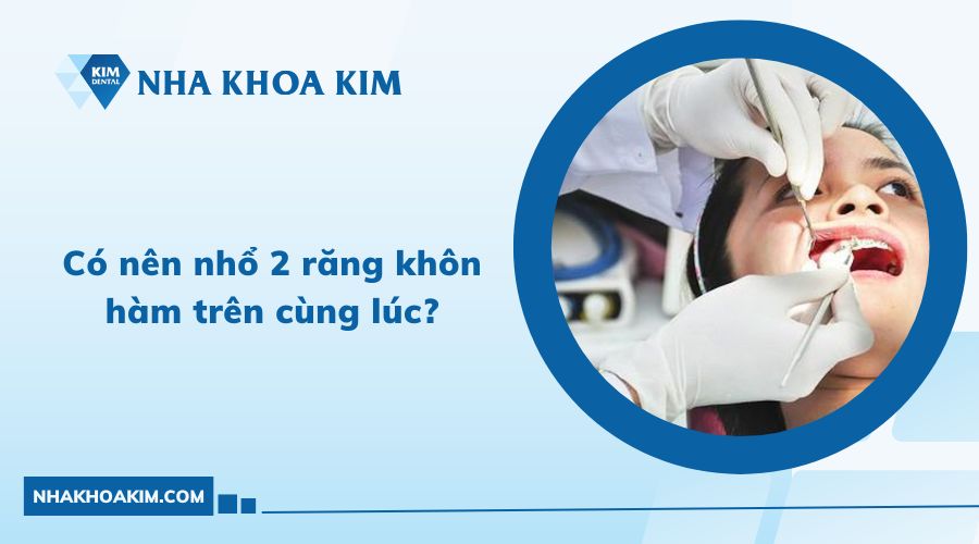 có nên nhổ 2 răng khôn hàm trên cùng lúc 