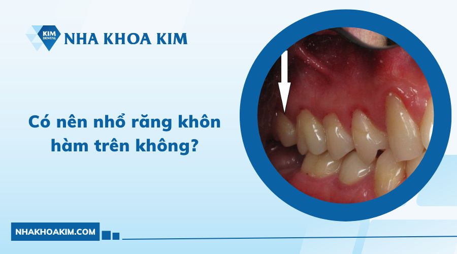 có nên nhổ răng khôn hàm trên không