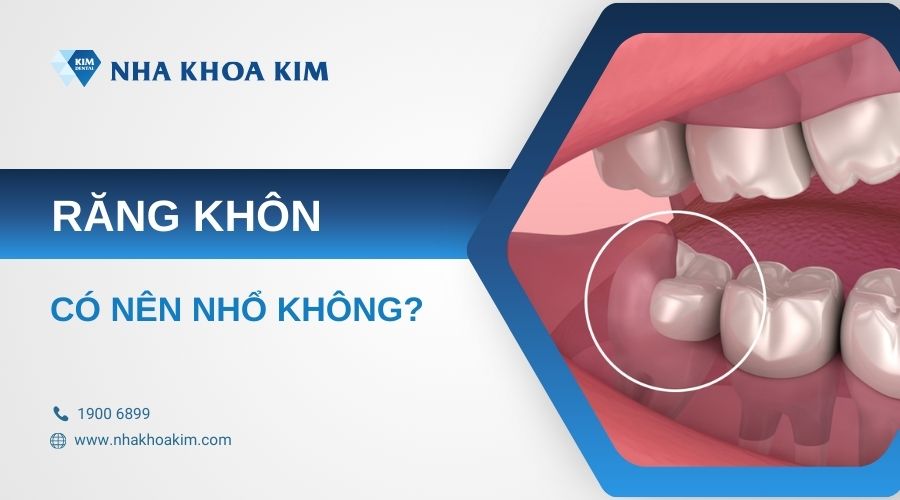 có nên nhổ răng khôn không