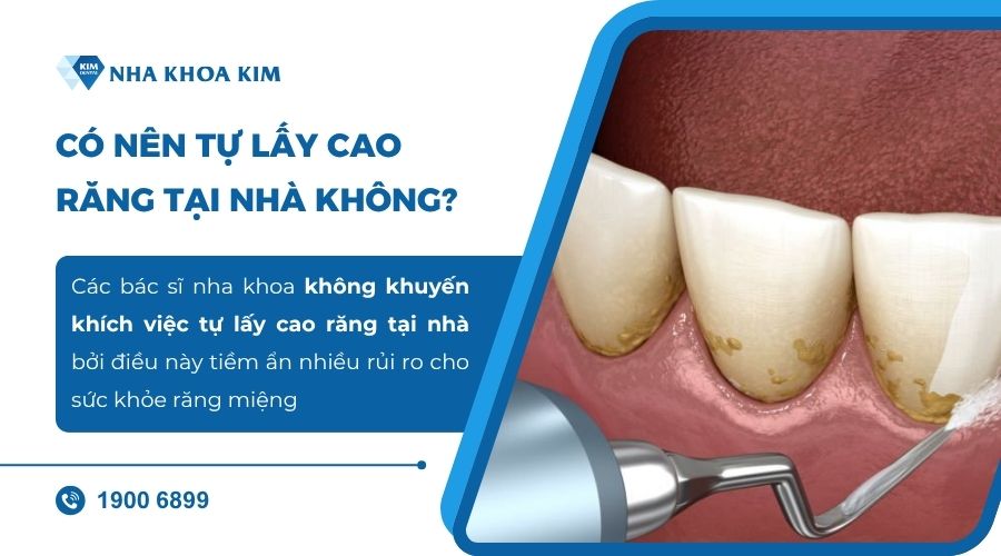 Có nên tự lấy cao răng tại nhà không?