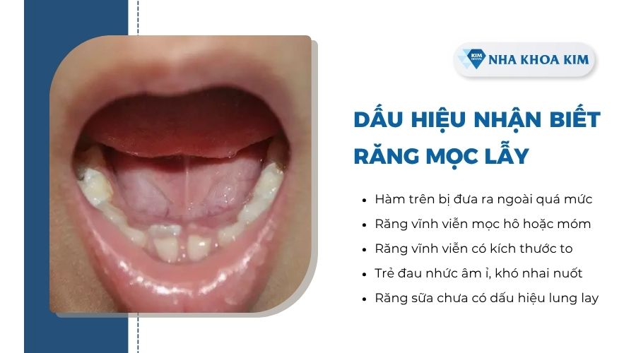 Dấu hiệu nhận biết răng mọc lẫy