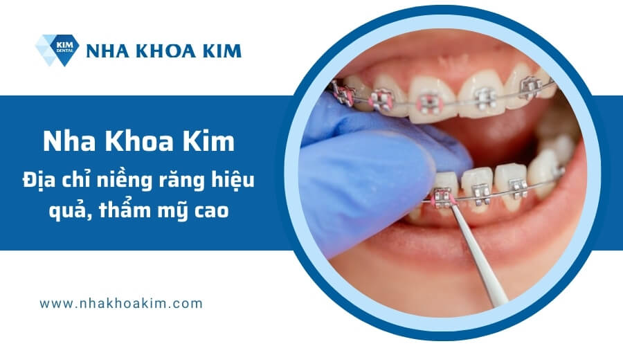 Địa chỉ nha khoa niềng răng 1 hàm an toàn, uy tín