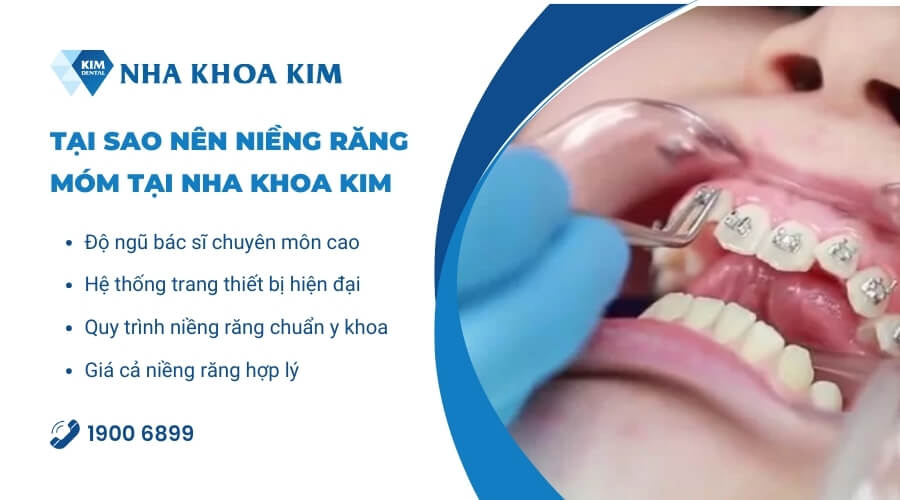 Hệ thống nha khoa niềng răng móm an toàn, chất lượng