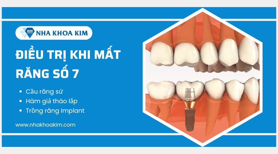 Phục hồi mất răng số 7