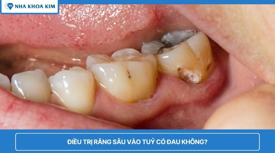 điều trị răng sâu có đau không