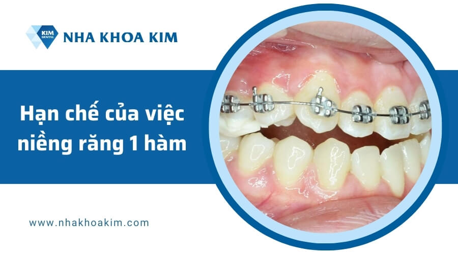 Hạn chế của việc niềng răng 1 hàm