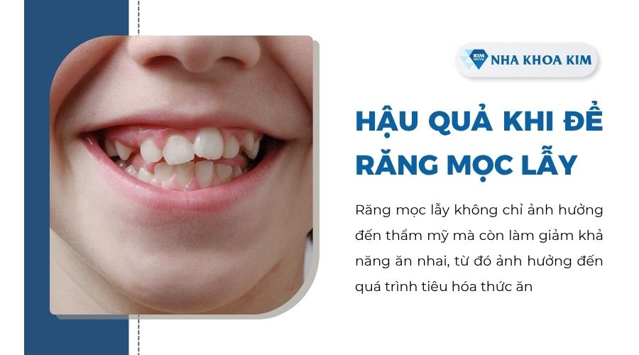 Răng mọc lẫy gây ra hậu quả gì?