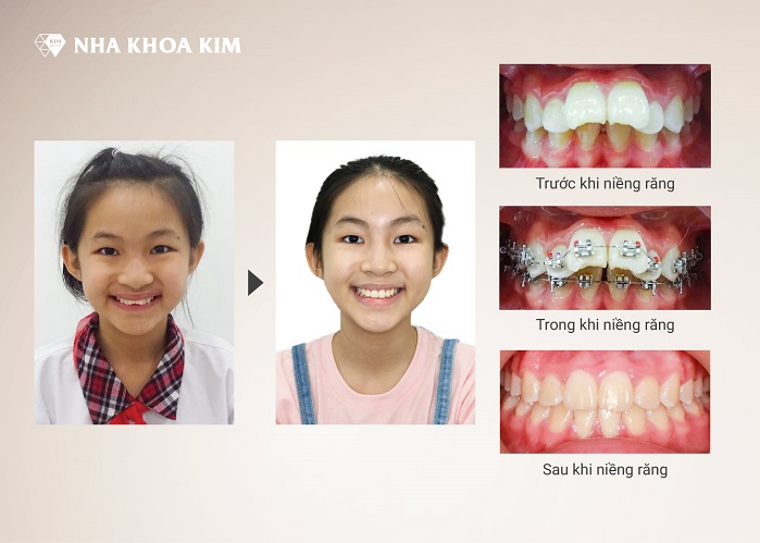 Hình ảnh khách hàng trước và khi niềng răng