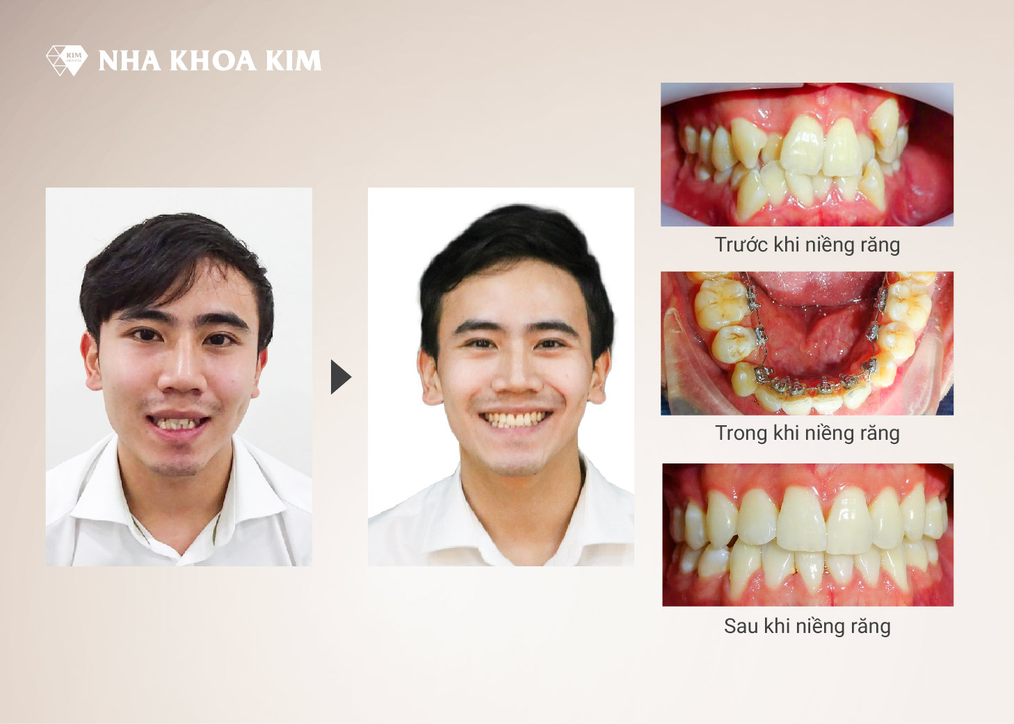 Hình ảnh khách hàng trước và khi niềng răng