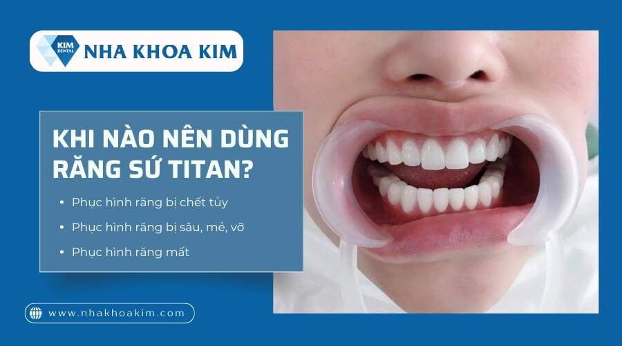 Khi nào nên sử dụng răng sứ Titan?