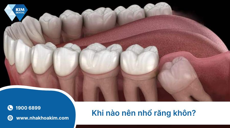 khi nào nên nhổ răng khôn?