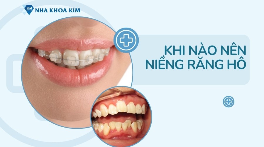 Khi nào nên niềng răng hô?