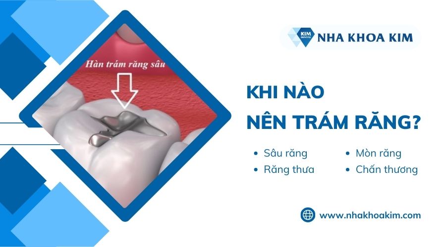 khi nào nên trám răng