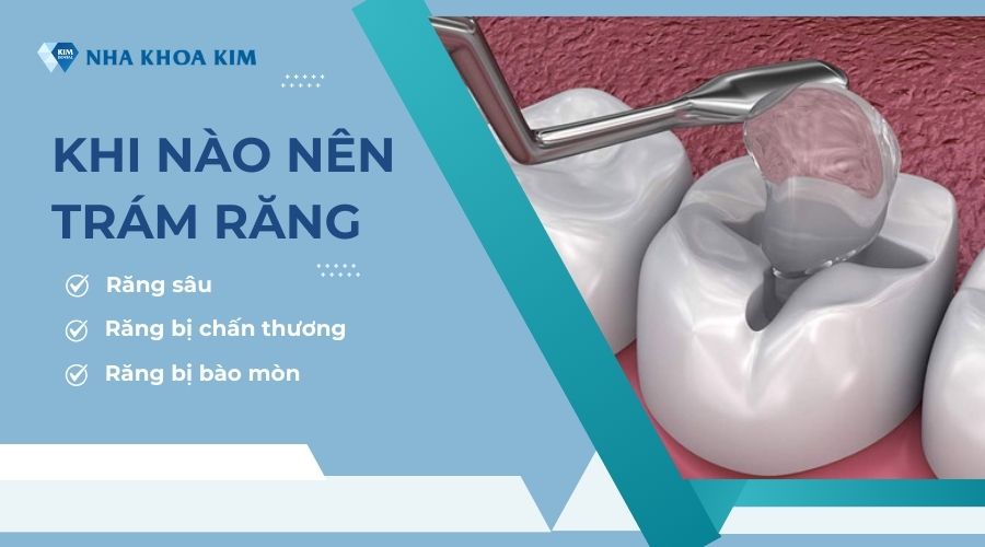 Khi nào nên trám răng?