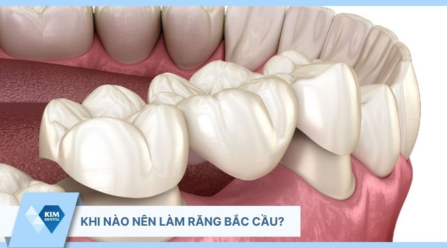 khi nào nên làm răng sứ bắc cầu