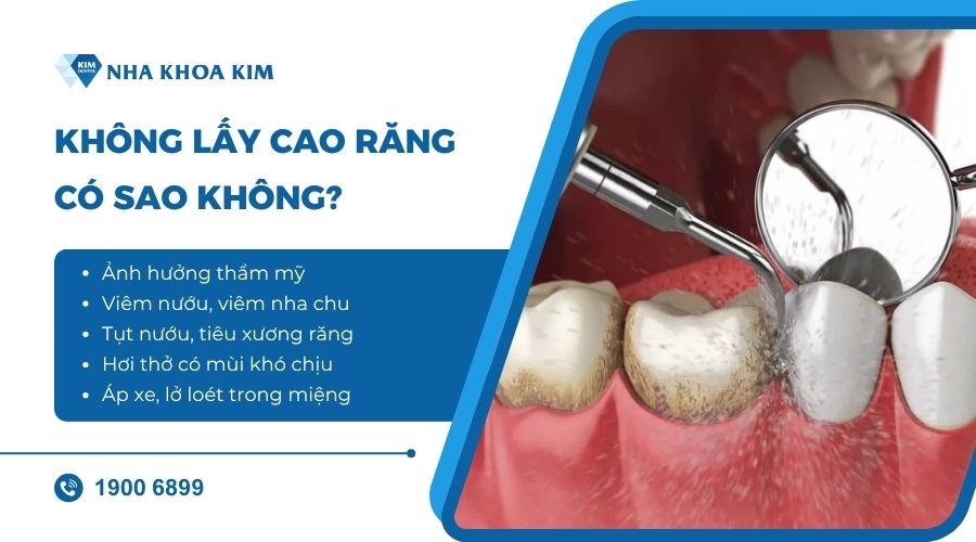 Không lấy cao răng có sao không?