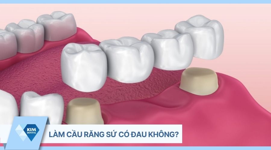 làm cầu răng sứ được bao nhiêu lâu