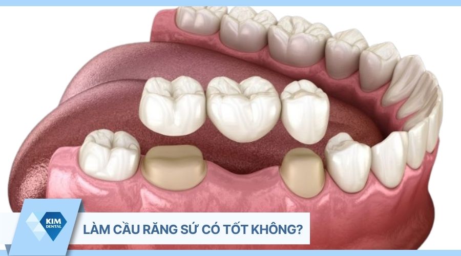làm cầu răng sứ có tốt không