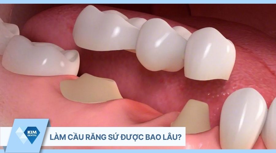 làm cầu răng sứ được bao nhiêu lâu