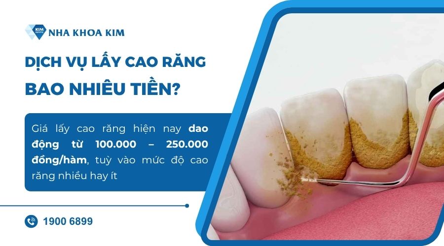 Lấy cao răng bao nhiêu tiền?